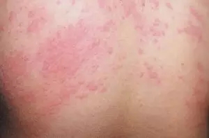 皮肤科医生揭秘：荨麻疹不治危及生命